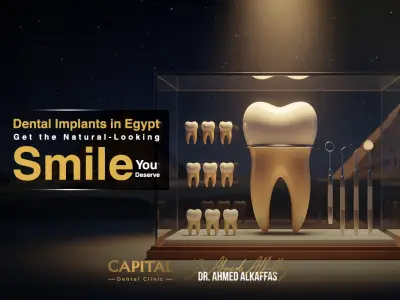 Dental Implants in Egypt – Get the Natural-Looking Smile You Deserve